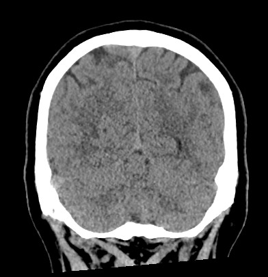 File:Acute internal carotid artery dissection (Radiopaedia 53541-59558 Coronal non-contrast 60).jpg