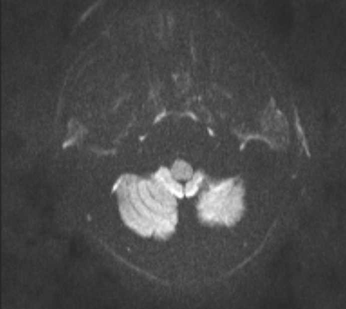 Acute ischemic stroke - posterior circulation territory (Radiopaedia 77670-89880 Axial DWI 49).jpg