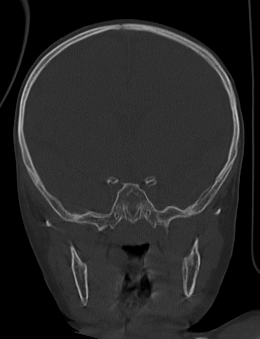 Acute mastoiditis (Radiopaedia 82678-96881 Coronal bone window 31).jpg