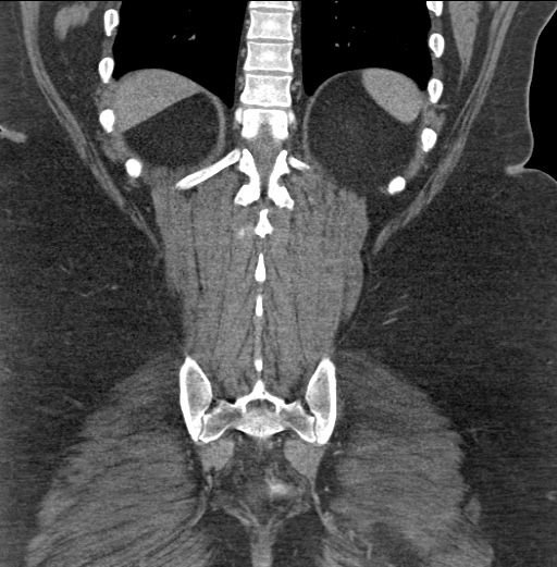Acute mesenteric venous ischemia (Radiopaedia 46041-50383 Coronal C+ portal venous phase 79).jpg