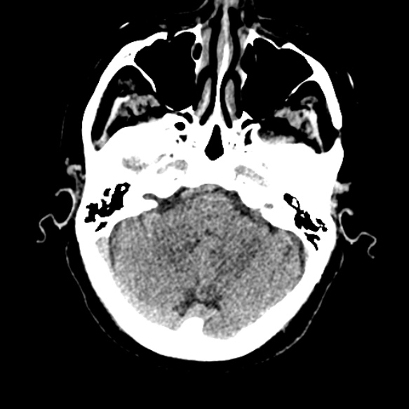 Acute middle cerebral artery territory infarct (Radiopaedia 52380-58283 Axial non-contrast 21).jpg