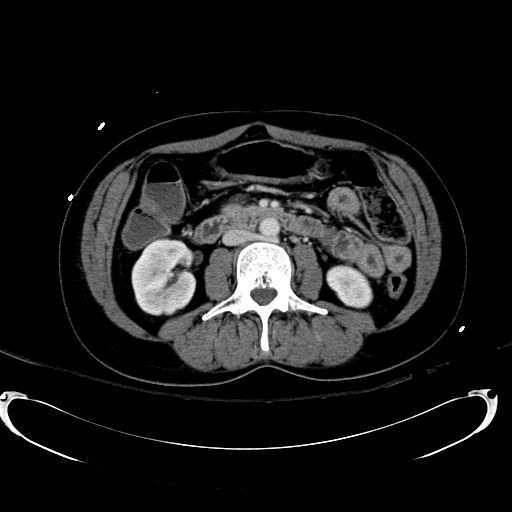 File:Acute myocardial infarction in CT (Radiopaedia 39947-42415 Axial C+ portal venous phase 62).jpg