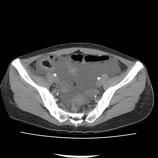 Acute myocarditis (Radiopaedia 55988-62613 Axial C+ portal venous phase 63).jpg