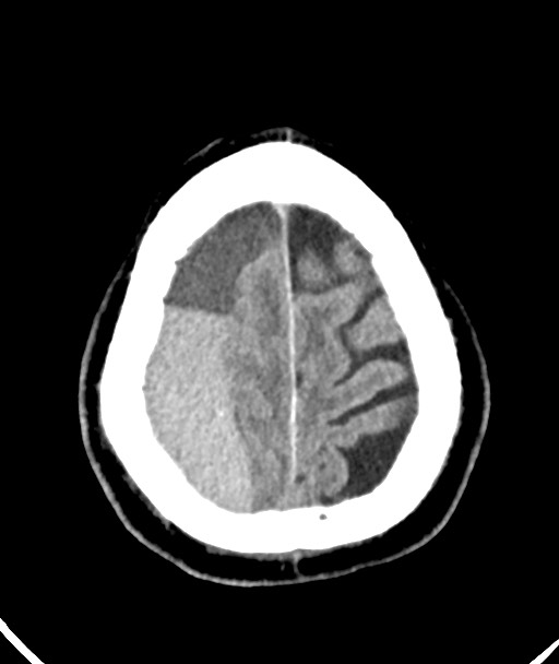 Acute on chronic subdural hematoma (Radiopaedia 78346-90966 Axial non-contrast 49).jpg