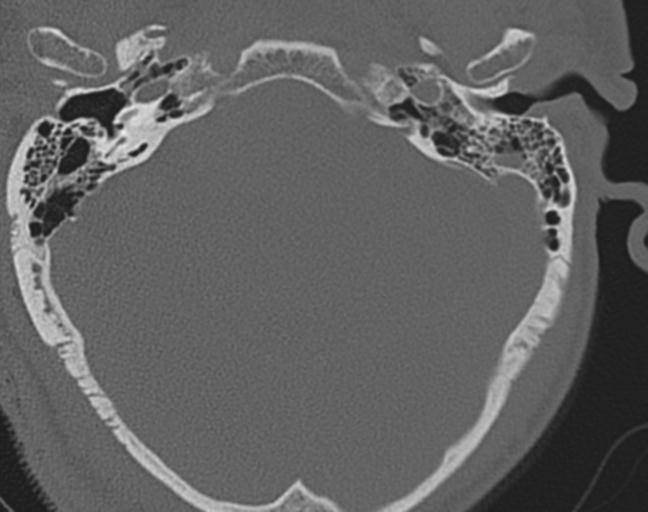 Acute on chronic subdural hematoma and thoracic vertebral injury in a multitrauma patient (Radiopaedia 31698-32619 Axial bone window 2).jpg