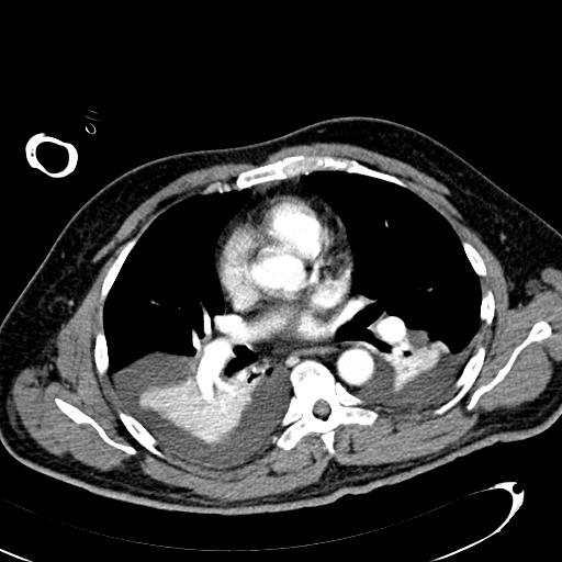 File:Acute pancreatic necrosis (Radiopaedia 13560-13486 Axial C+ portal venous phase 1).jpg