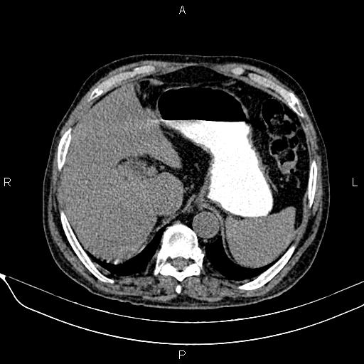 Acute pancreatitis (Radiopaedia 85146-100701 Axial non-contrast 28).jpg