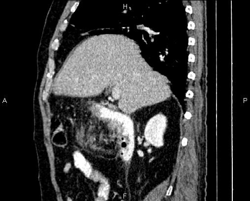 File:Acute pancreatitis (Radiopaedia 85146-100701 Sagittal C+ portal venous phase 30).jpg