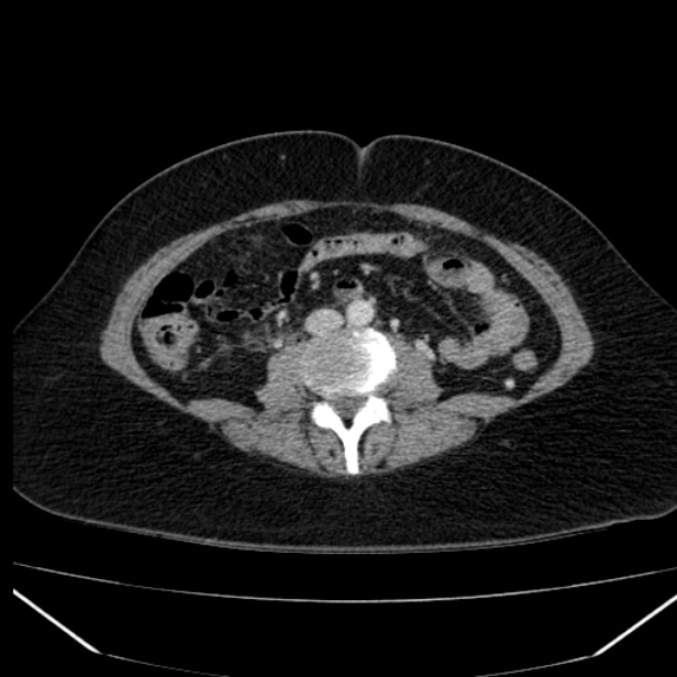 Acute pancreatitis - Balthazar C (Radiopaedia 26569-26714 Axial C+ portal venous phase 57).jpg