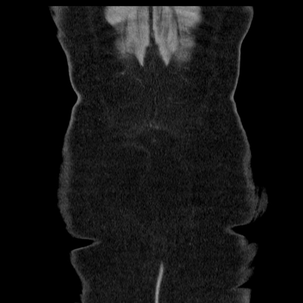 Acute pancreatitis - Balthazar C (Radiopaedia 26569-26714 Coronal C+ portal venous phase 68).jpg