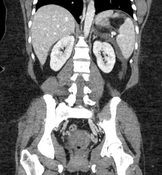 Acute pancreatitis - Balthazar E (Radiopaedia 29016-29377 Coronal C+ portal venous phase 62).png