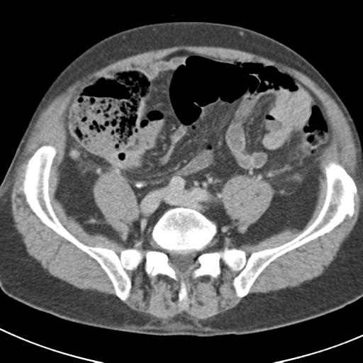 Acute pancreatitis and walled-off necrosis (Radiopaedia 29888-30403 Axial C+ delayed 59).jpg
