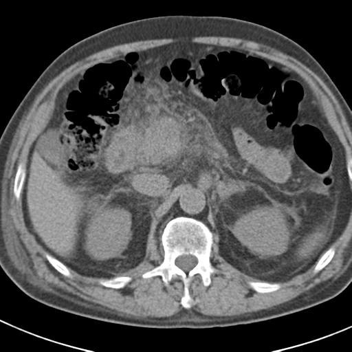 File:Acute pancreatitis and walled-off necrosis (Radiopaedia 29888-30403 Axial non-contrast 23).jpg