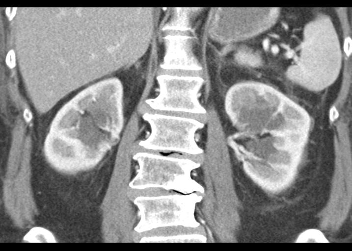 File:Acute pancreatitis and walled-off necrosis (Radiopaedia 29888-30403 Coronal C+ portal venous phase 39).jpg