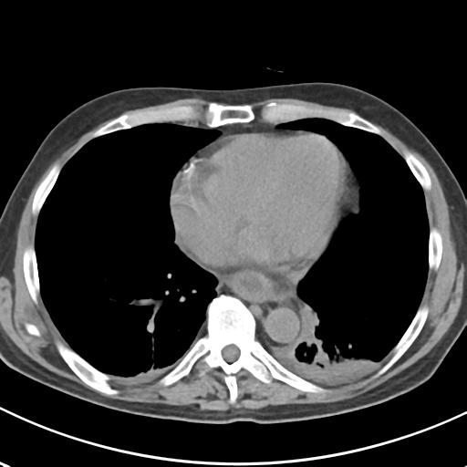 File:Acute pancreatitis and walled-off necrosis (Radiopaedia 29888-30404 Axial non-contrast 1).jpg