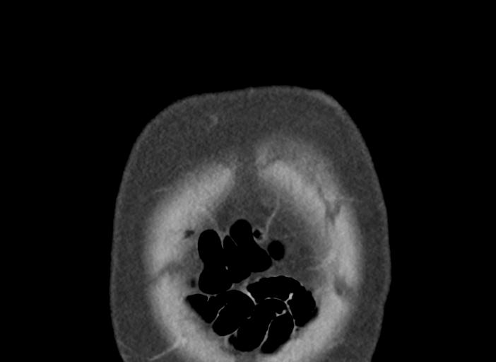 Acute pancreatitis and walled-off necrosis (Radiopaedia 29888-30404 Coronal C+ portal venous phase 5).jpg