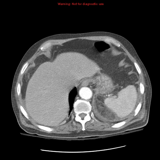 File:Acute pancreatitis with incidental pancreatic lipoma (Radiopaedia 10190-10730 Axial C+ arterial phase 19).jpg