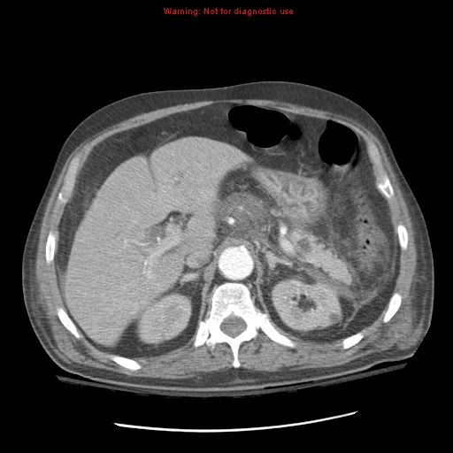 File:Acute pancreatitis with incidental pancreatic lipoma (Radiopaedia 10190-10730 Axial C+ arterial phase 31).jpg