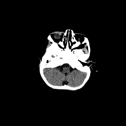 Acute phase of hemiconvulsion-hemiplegia epilepsy syndrome (Radiopaedia 29309-29744 Axial non-contrast 44).jpg