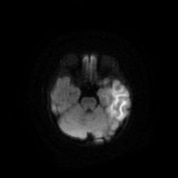 File:Acute phase of hemiconvulsion-hemiplegia epilepsy syndrome (Radiopaedia 29309-29745 Axial DWI 9).jpg