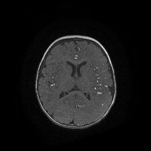 Acute phase of hemiconvulsion-hemiplegia epilepsy syndrome (Radiopaedia 29309-29745 Axial TOF angiography 40).jpg
