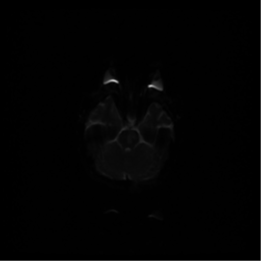 File:Acute pontine infarct from vertebral artery dissection (Radiopaedia 34111-35370 Axial DWI 31).png
