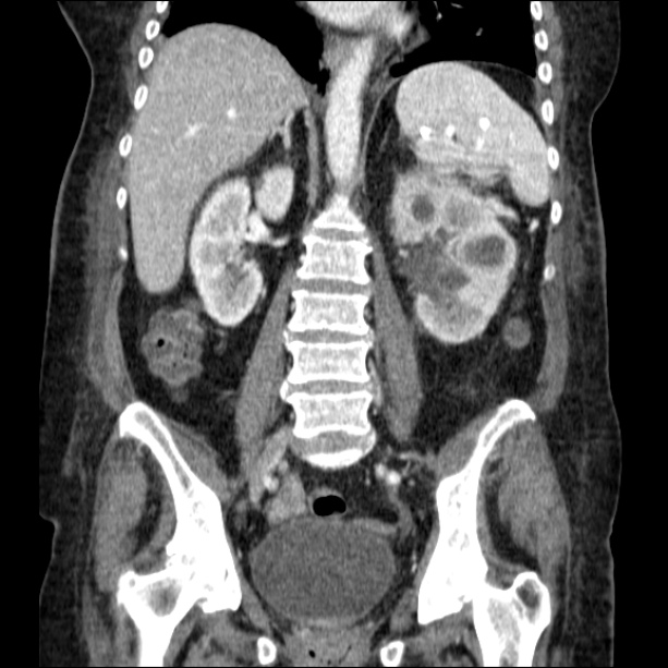Acute pyelonephritis (Radiopaedia 26584-26729 C+ portal venous phase 44).jpg