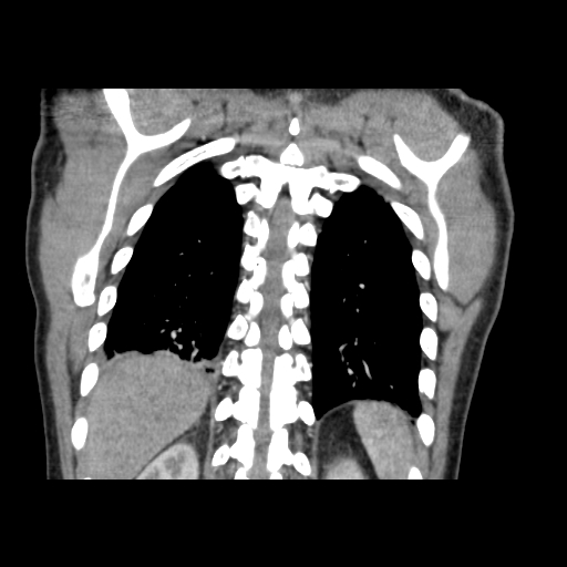 Acute segmental pulmonary emboli and pulmonary infarction (Radiopaedia 62264-70444 Coronal C+ CTPA 46).jpg