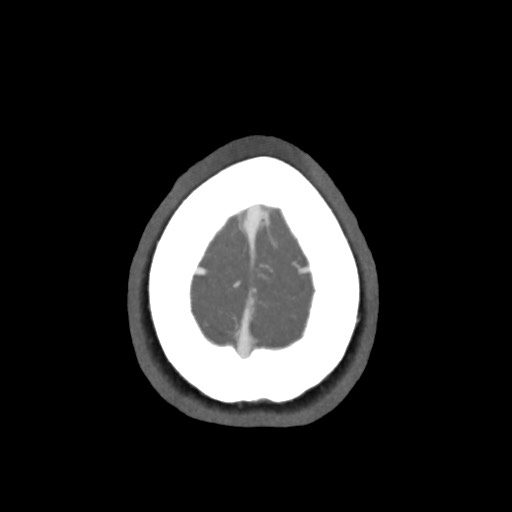 Acute subarachnoid hemorrhage and accessory anterior cerebral artery (Radiopaedia 69231-79009 D 66).jpg