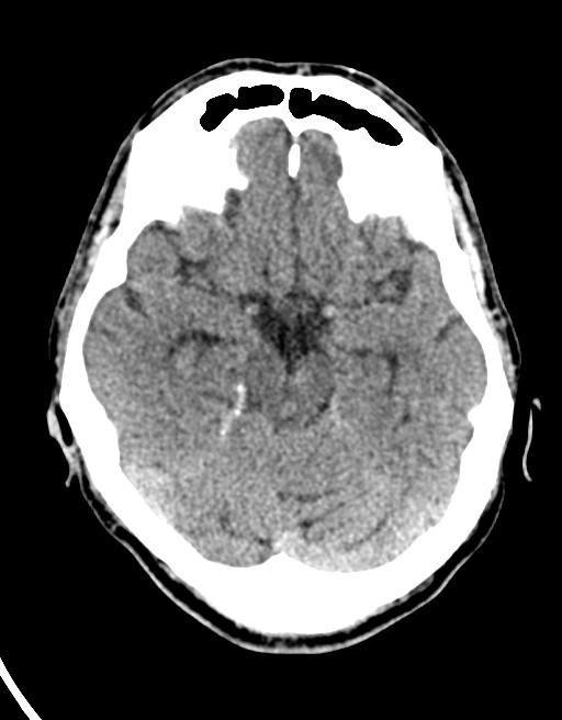 Acute superior cerebellar artery territory infarct (Radiopaedia 84104-99359 Axial non-contrast 44).jpg