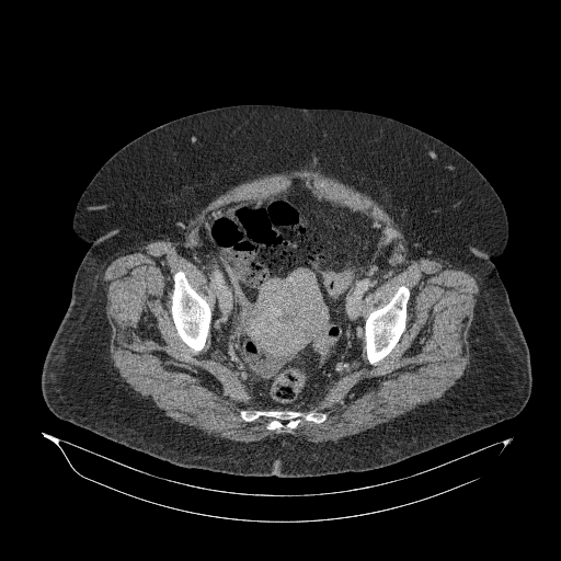 Acute superior mesenteric artery occlusion (Radiopaedia 51288-56960 Axial C+ portal venous phase 88).jpg