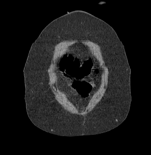 File:Acute superior mesenteric artery occlusion (Radiopaedia 51288-56960 Coronal C+ portal venous phase 6).jpg