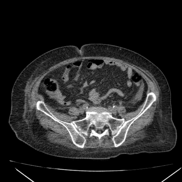Acute tubular necrosis (Radiopaedia 28077-28334 Axial non-contrast 49).jpg