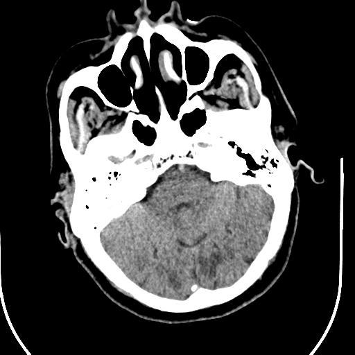 Acute vertebrobasilar ischemic infarction (Radiopaedia 25220-25473 Axial non-contrast 17).jpg