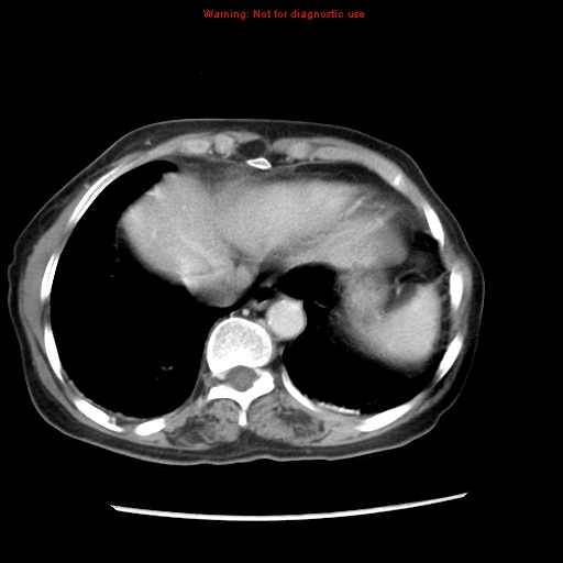 Adenocarcinoma of the colon (Radiopaedia 8191-9039 Axial liver window 11).jpg