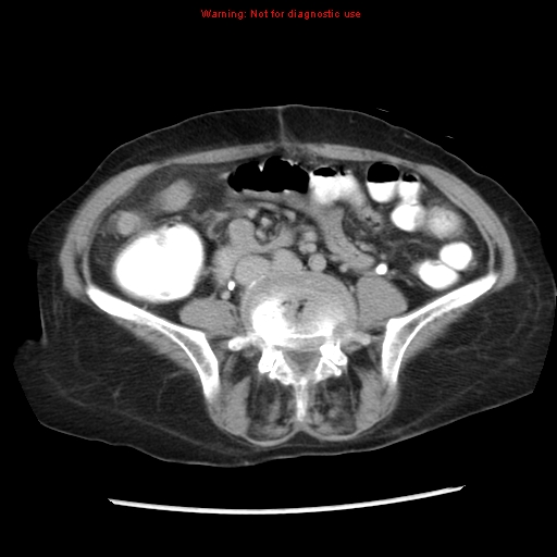 File:Adenocarcinoma of the colon (Radiopaedia 8191-9039 Axial renal excretory phase 33).jpg