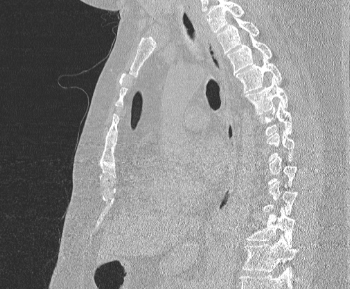 File:Adenoid cystic carcinoma of the trachea (Radiopaedia 49042-54137 Sagittal lung window 253).jpg
