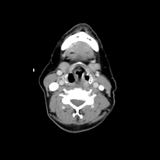 File:Adenoid cystic tumor of palate (Radiopaedia 46980-51518 Axial C+ delayed 46).png