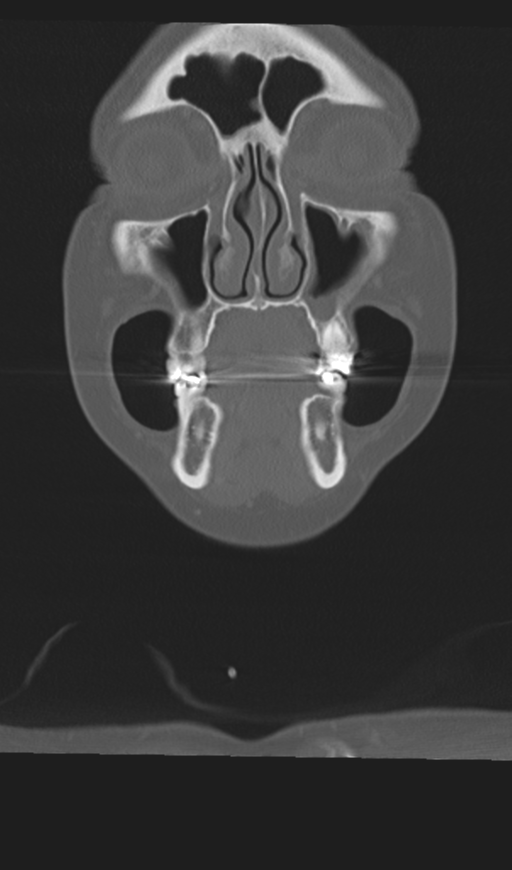 Adenoid cystic tumor of palate (Radiopaedia 46980-51518 Coronal bone window 16).png