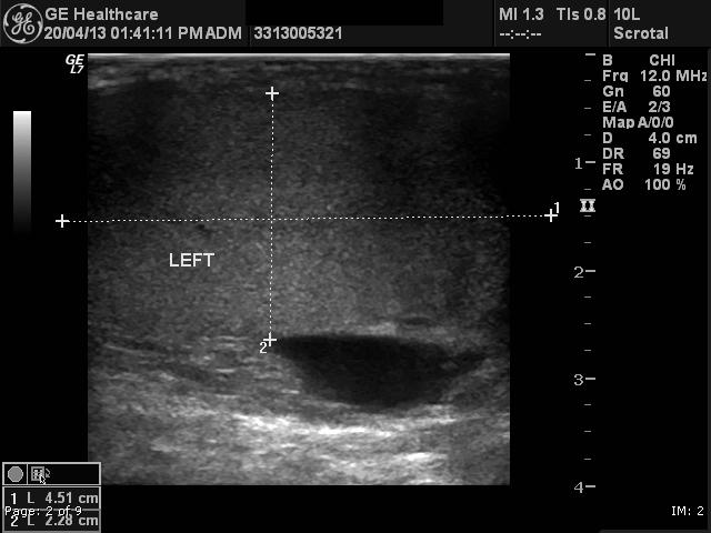 File:Adenomatoid tumor of the scrotum (Radiopaedia 22739-22762 D 1).jpg