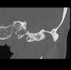 File:Adhesive chronic otitis media (Radiopaedia 14270-14148 Coronal bone window - left 2).jpg