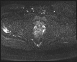 Adnexal multilocular cyst (O-RADS US 3- O-RADS MRI 3) (Radiopaedia 87426-103754 Axial DWI 51).jpg