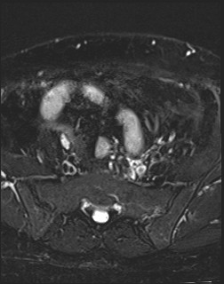 File:Adnexal multilocular cyst (O-RADS US 3- O-RADS MRI 3) (Radiopaedia 87426-103754 Axial T2 fat sat 4).jpg