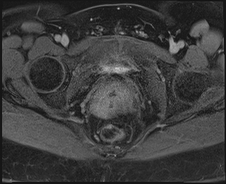 File:Adnexal multilocular cyst (O-RADS US 3. O-RADS MRI 3) (Radiopaedia 87426-103754 Axial 244).jpeg