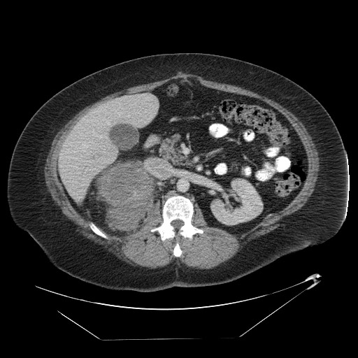 Adrenal angiosarcoma (Radiopaedia 81081-94671 Axial C+ portal venous phase 32).jpg