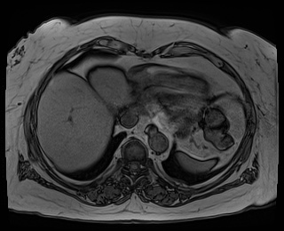 File:Adrenal cortical carcinoma (Radiopaedia 64017-72770 Axial T1 out-of-phase 2).jpg