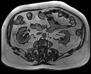 File:Adrenal cortical carcinoma (Radiopaedia 64017-72770 Axial T1 out-of-phase 44).jpg