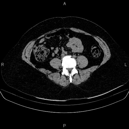 File:Adrenal cortical carcinoma (Radiopaedia 84882-100379 Axial non-contrast 59).jpg