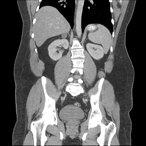 Adrenal cyst (Radiopaedia 45625-49776 Coronal C+ portal venous phase 48).png
