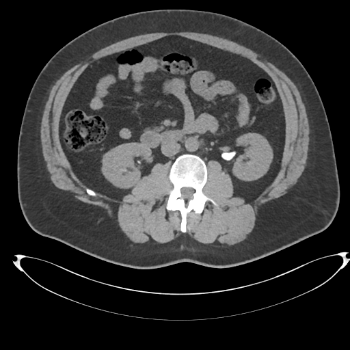 File:Adrenal cyst (Radiopaedia 45625-49778 Axial non-contrast 58).png